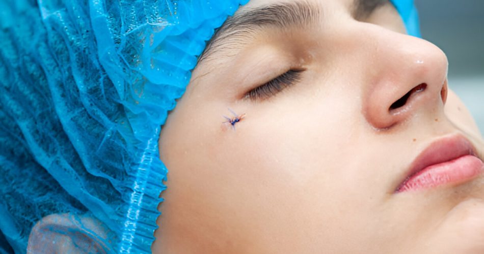 Facing Mohs Surgery